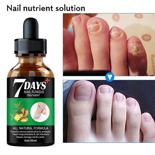 Serum voor schimmelnagels
